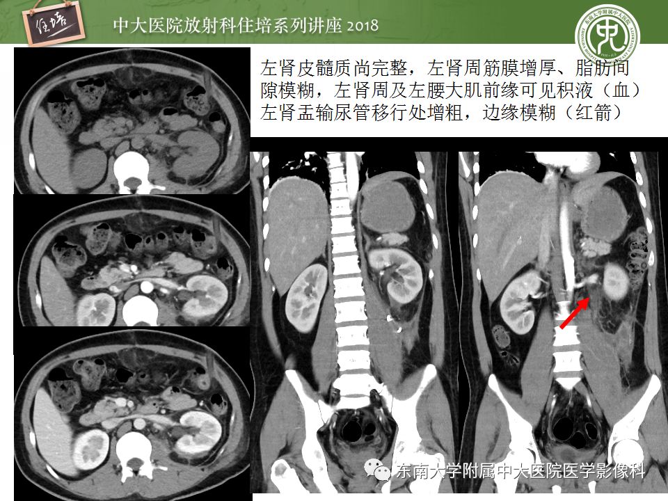 【PPT】腹膜后外伤的CT表现