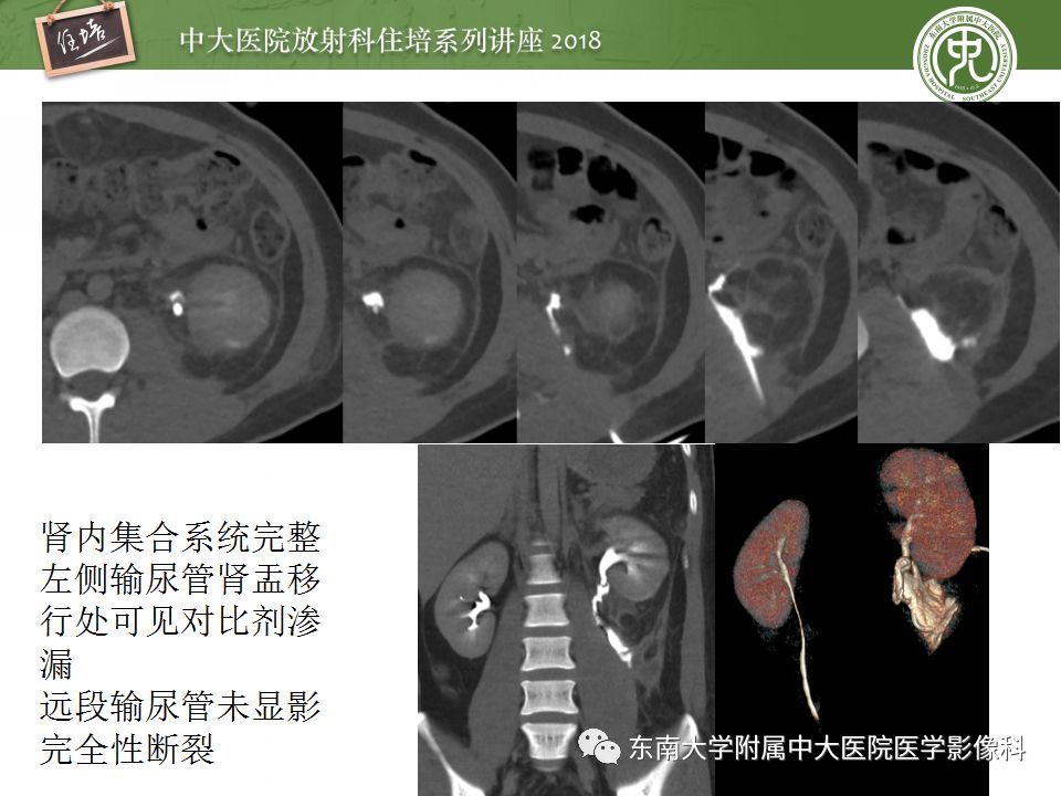 【PPT】腹膜后外伤的CT表现