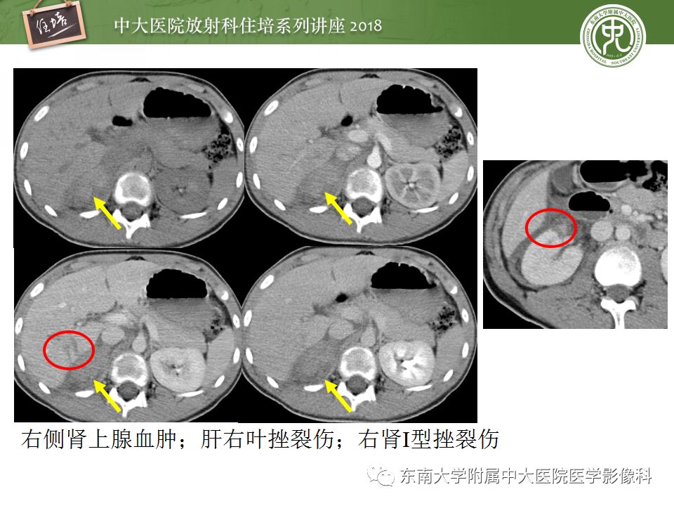 【PPT】腹膜后外伤的CT表现