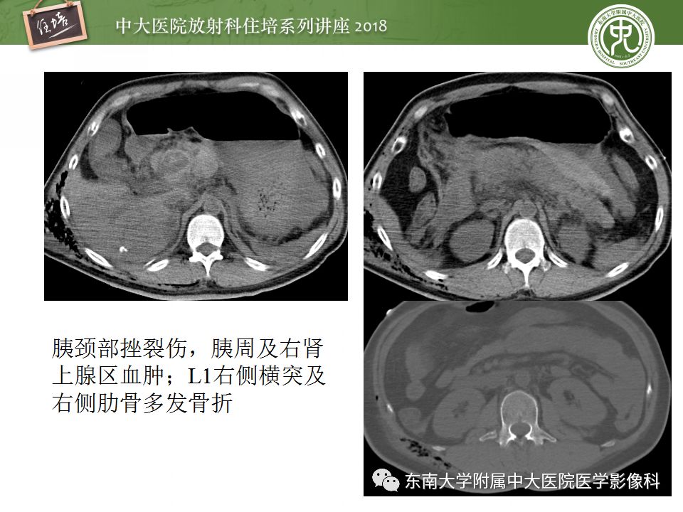 【PPT】腹膜后外伤的CT表现