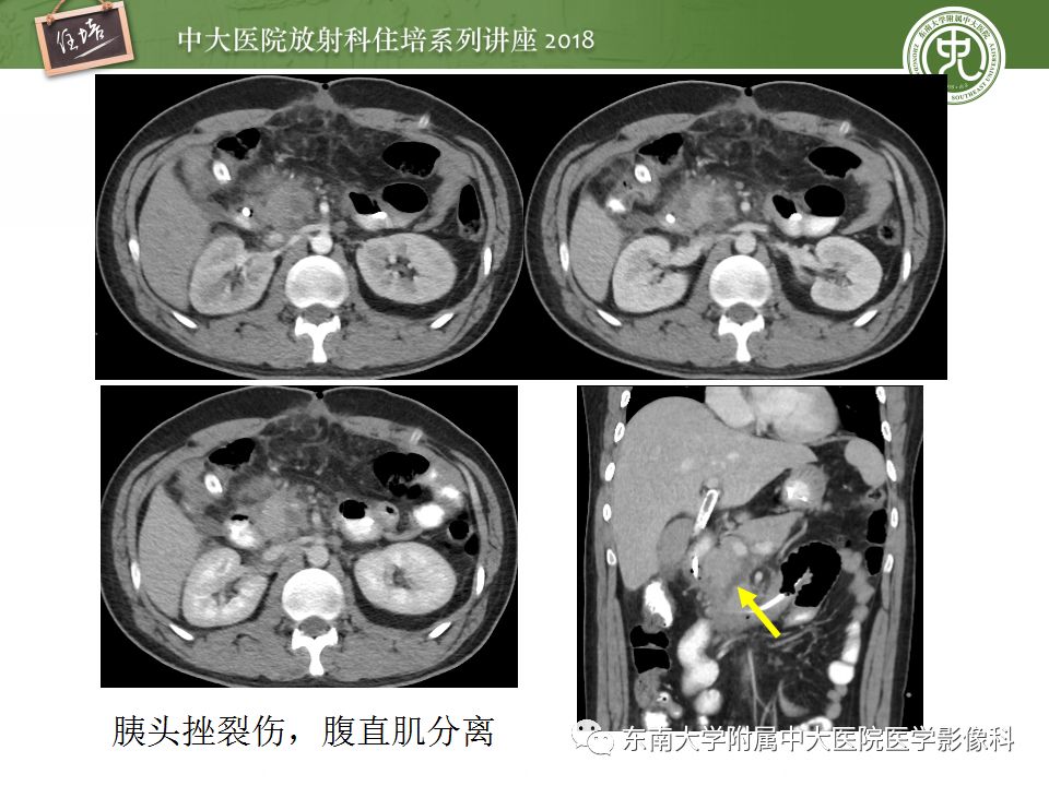 【PPT】腹膜后外伤的CT表现
