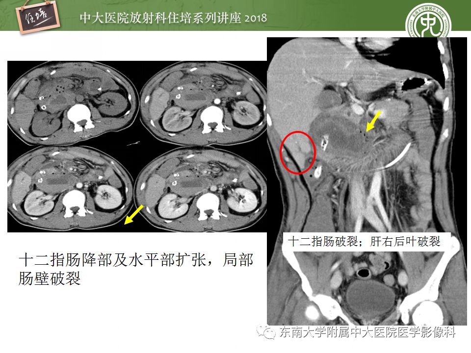 【PPT】腹膜后外伤的CT表现
