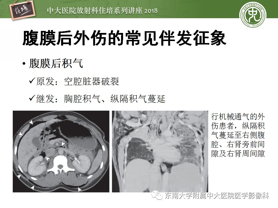 【PPT】腹膜后外伤的CT表现