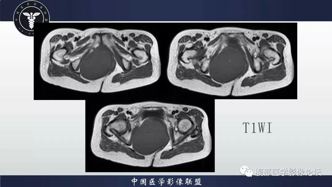 【病例】阴道壁囊性成熟性畸胎瘤1例MR影像