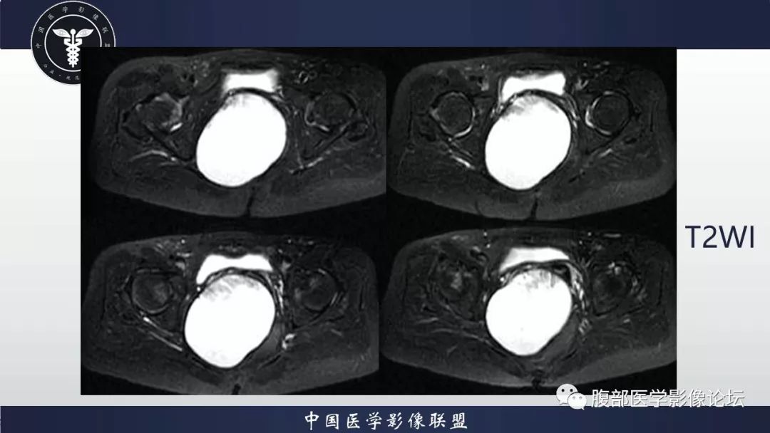 【病例】阴道壁囊性成熟性畸胎瘤1例MR影像