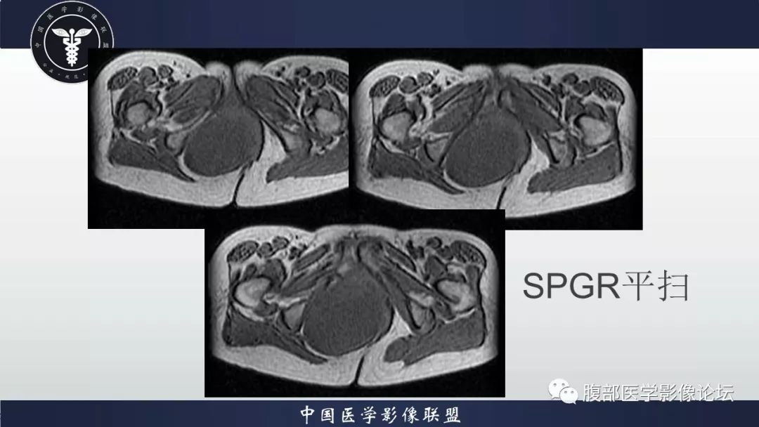 【病例】阴道壁囊性成熟性畸胎瘤1例MR影像