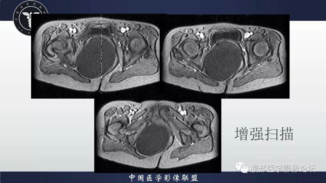【病例】阴道壁囊性成熟性畸胎瘤1例MR影像