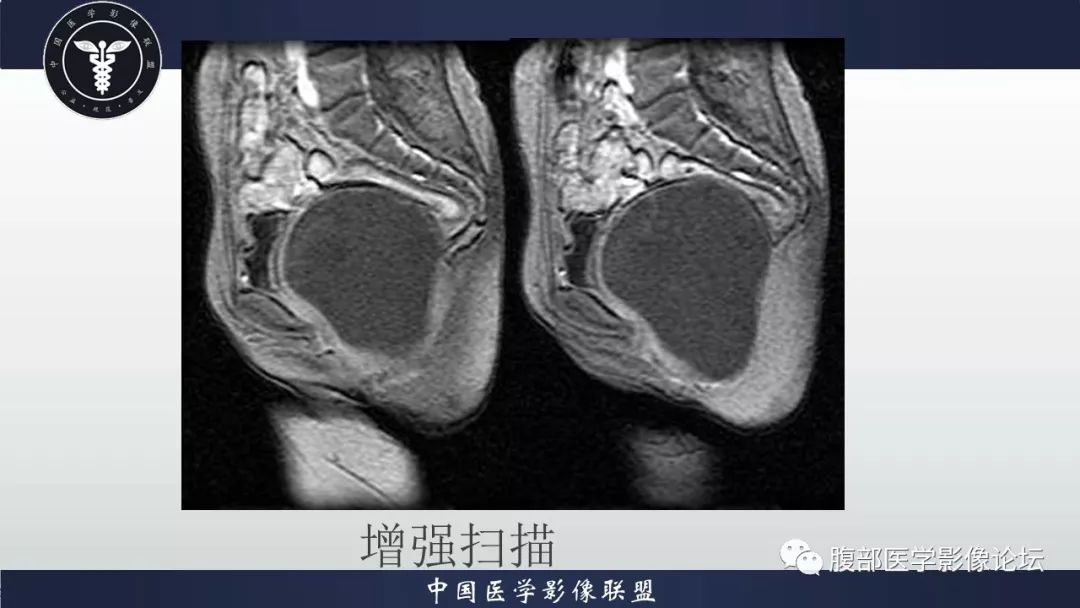 【病例】阴道壁囊性成熟性畸胎瘤1例MR影像