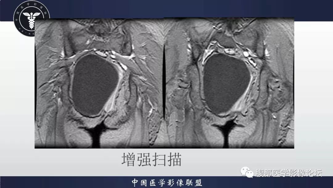 【病例】阴道壁囊性成熟性畸胎瘤1例MR影像