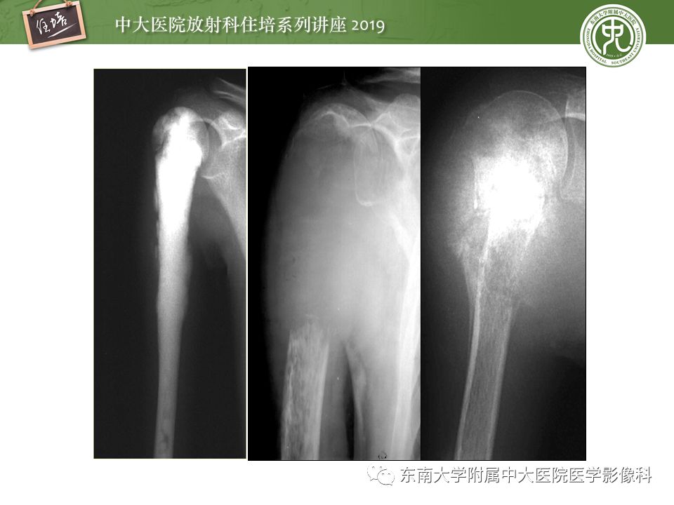 【PPT】常见恶性骨肿瘤的影像诊断