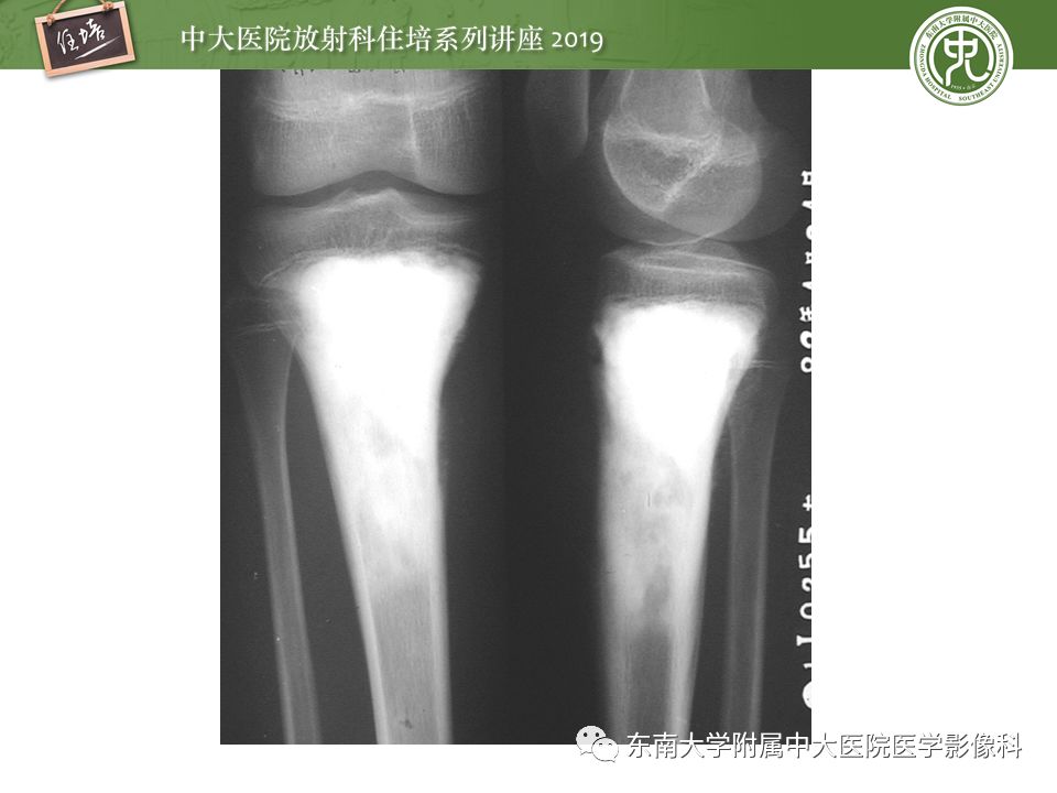 【PPT】常见恶性骨肿瘤的影像诊断