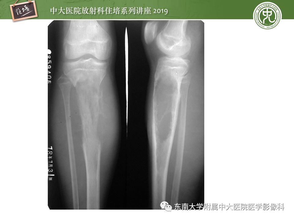 【PPT】常见恶性骨肿瘤的影像诊断