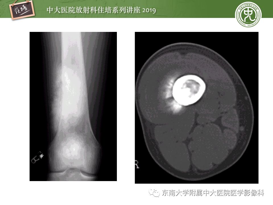 【PPT】常见恶性骨肿瘤的影像诊断