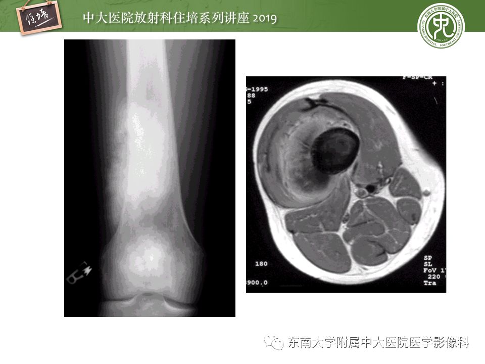 【PPT】常见恶性骨肿瘤的影像诊断