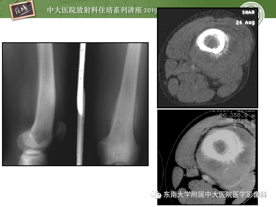 【PPT】常见恶性骨肿瘤的影像诊断