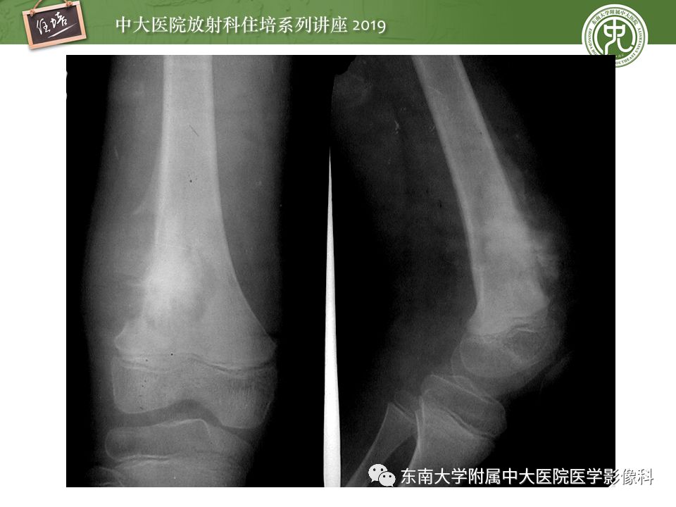 【PPT】常见恶性骨肿瘤的影像诊断