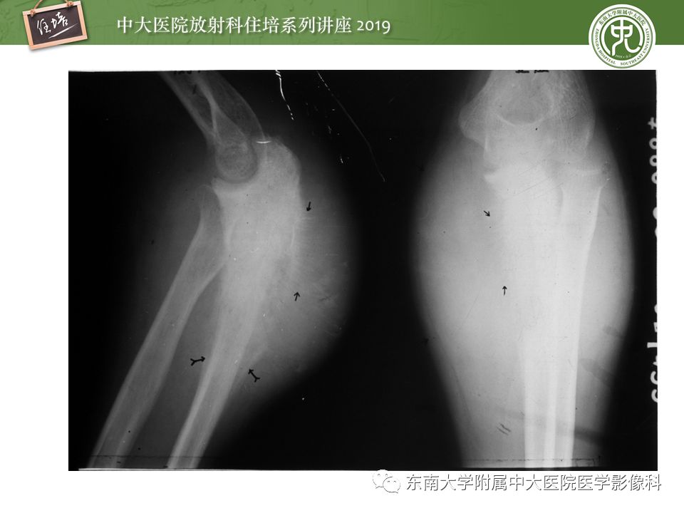 【PPT】常见恶性骨肿瘤的影像诊断