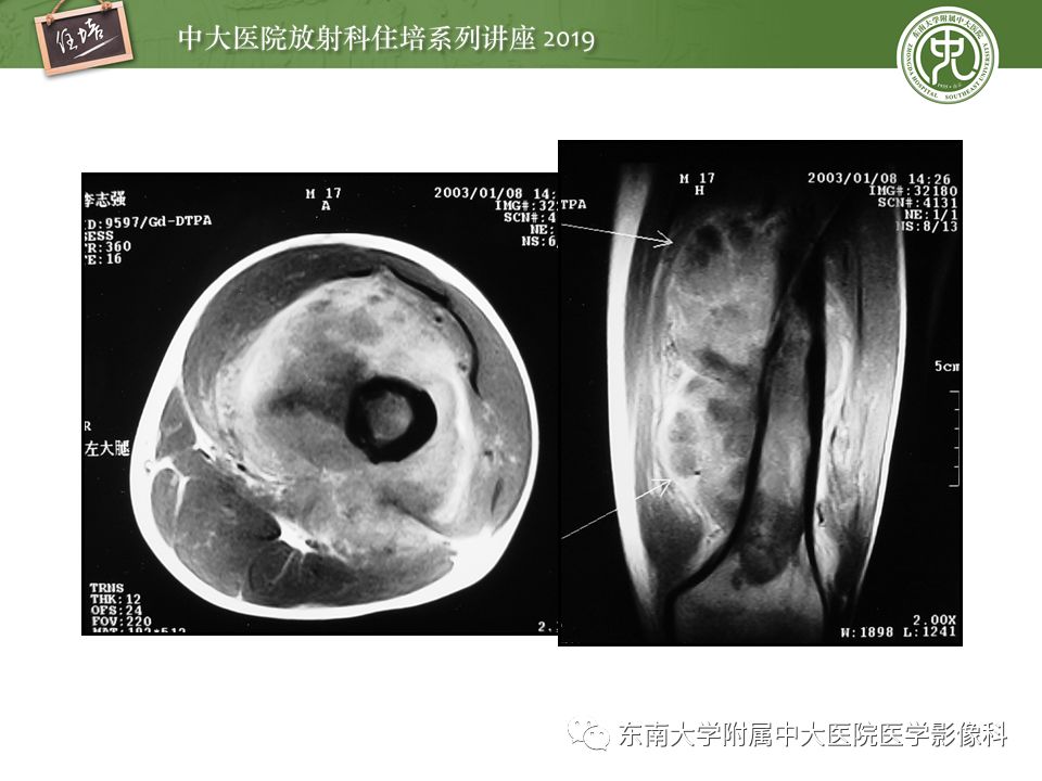 【PPT】常见恶性骨肿瘤的影像诊断