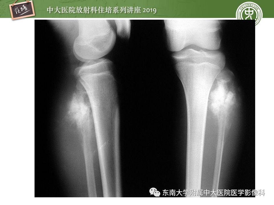 【PPT】常见恶性骨肿瘤的影像诊断