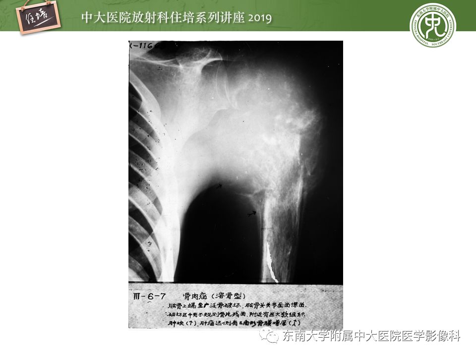 【PPT】常见恶性骨肿瘤的影像诊断