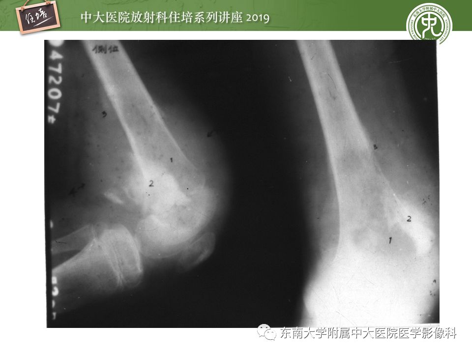 【PPT】常见恶性骨肿瘤的影像诊断