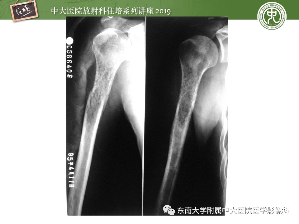 【PPT】常见恶性骨肿瘤的影像诊断