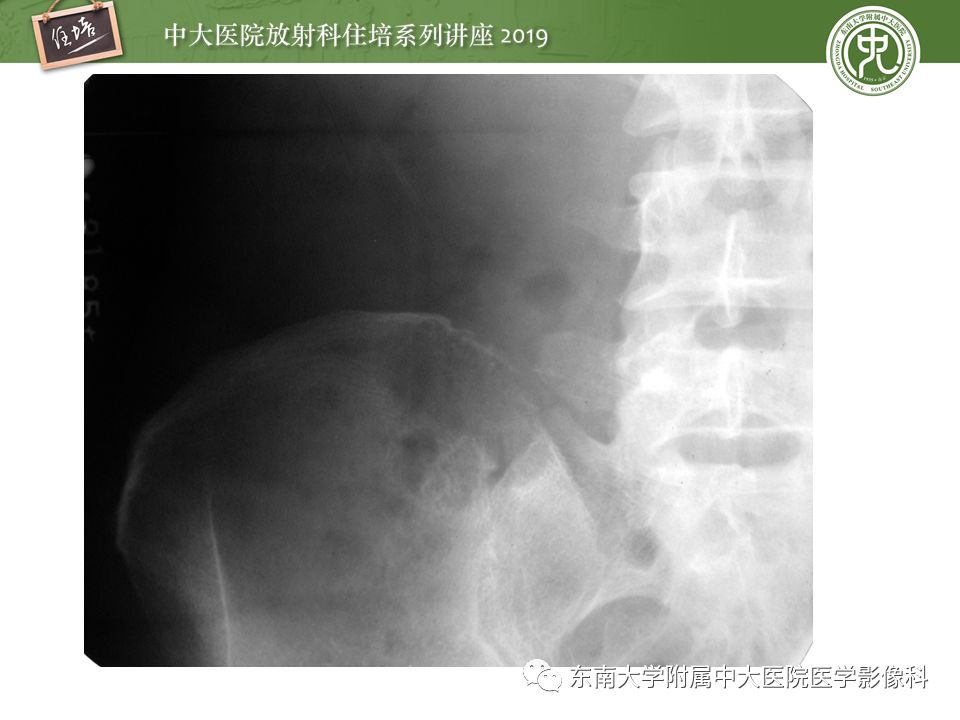 【PPT】常见恶性骨肿瘤的影像诊断