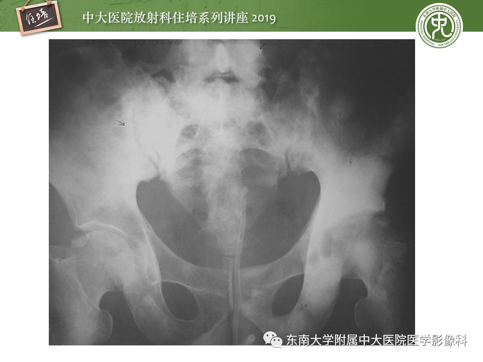 【PPT】常见恶性骨肿瘤的影像诊断