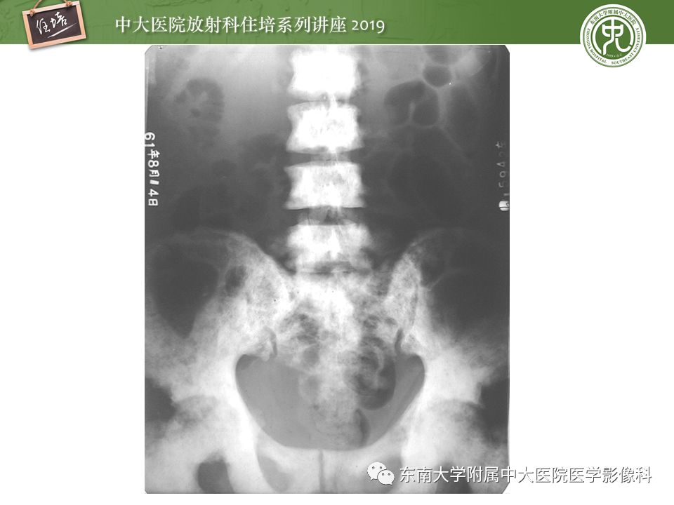 【PPT】常见恶性骨肿瘤的影像诊断