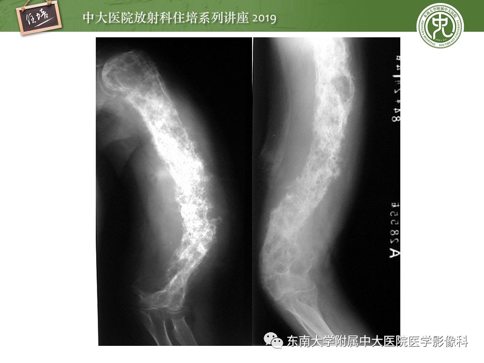 【PPT】常见恶性骨肿瘤的影像诊断