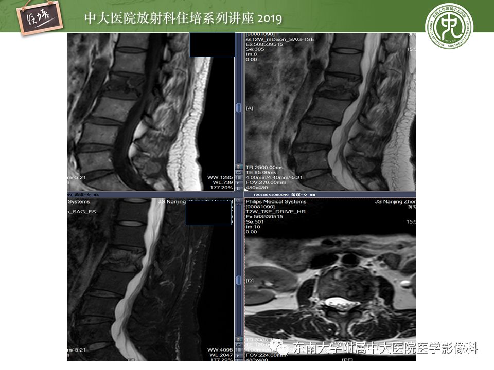 【PPT】常见恶性骨肿瘤的影像诊断