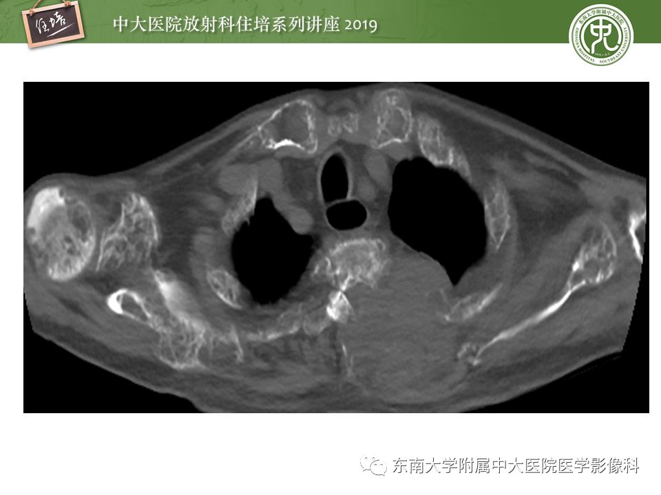 【PPT】常见恶性骨肿瘤的影像诊断