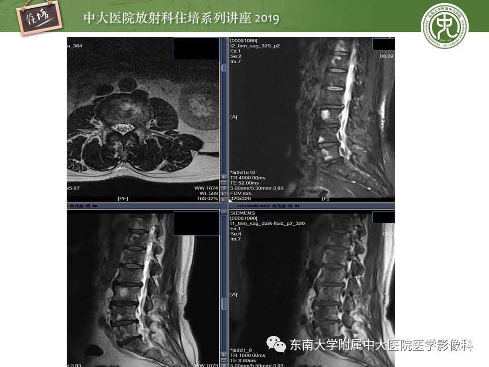 【PPT】常见恶性骨肿瘤的影像诊断