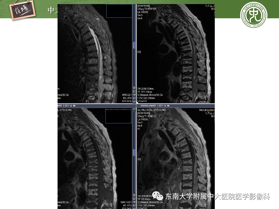【PPT】常见恶性骨肿瘤的影像诊断
