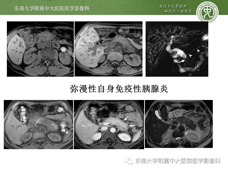【PPT】IgG4相关性胰腺炎影像诊断