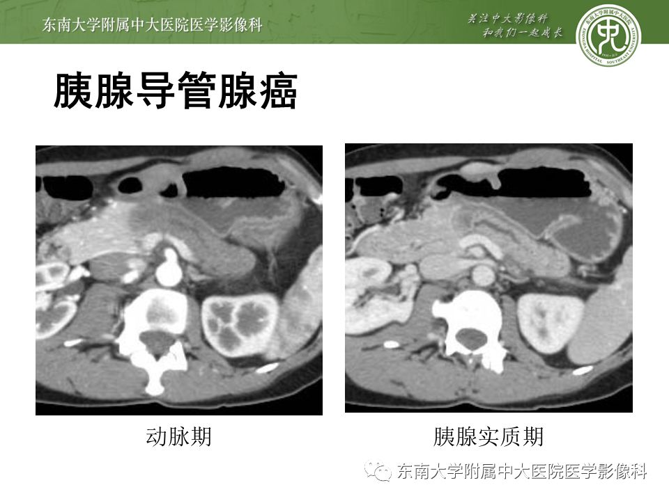 【PPT】IgG4相关性胰腺炎影像诊断