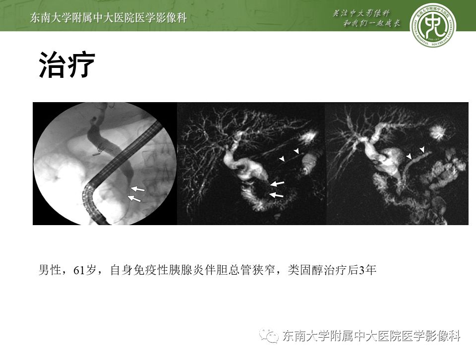 【PPT】IgG4相关性胰腺炎影像诊断