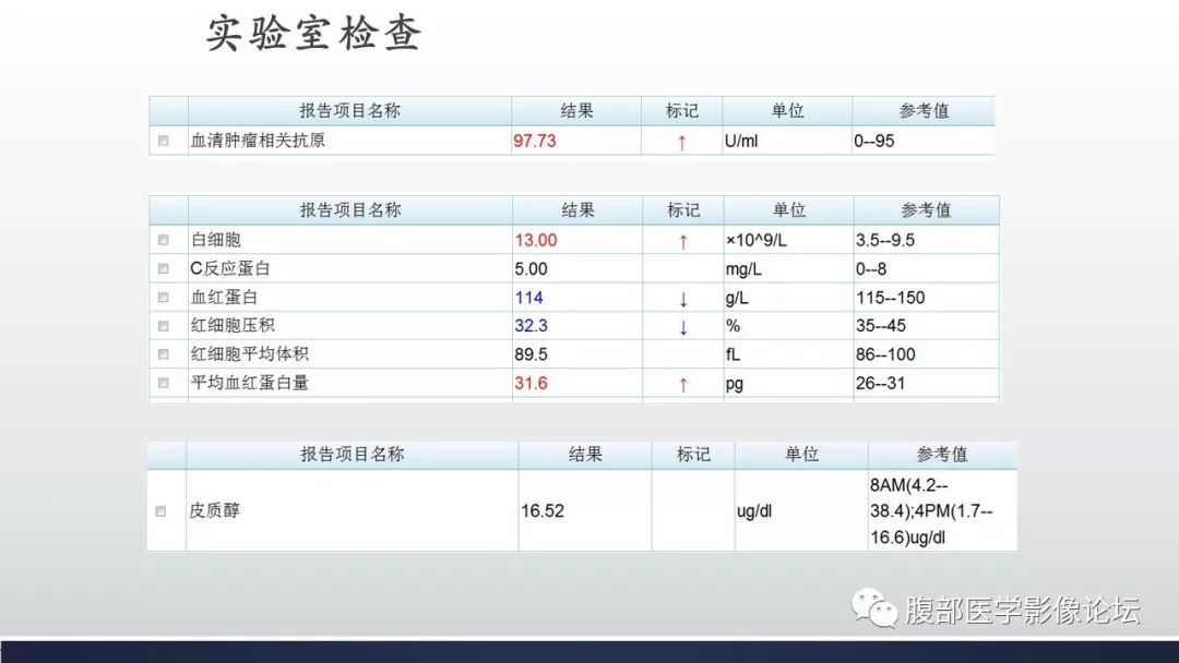 【病例】肾上腺平滑肌瘤1例CT影像鉴别诊断