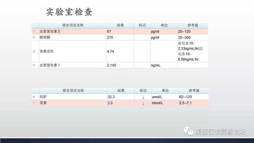 【病例】肾上腺平滑肌瘤1例CT影像鉴别诊断