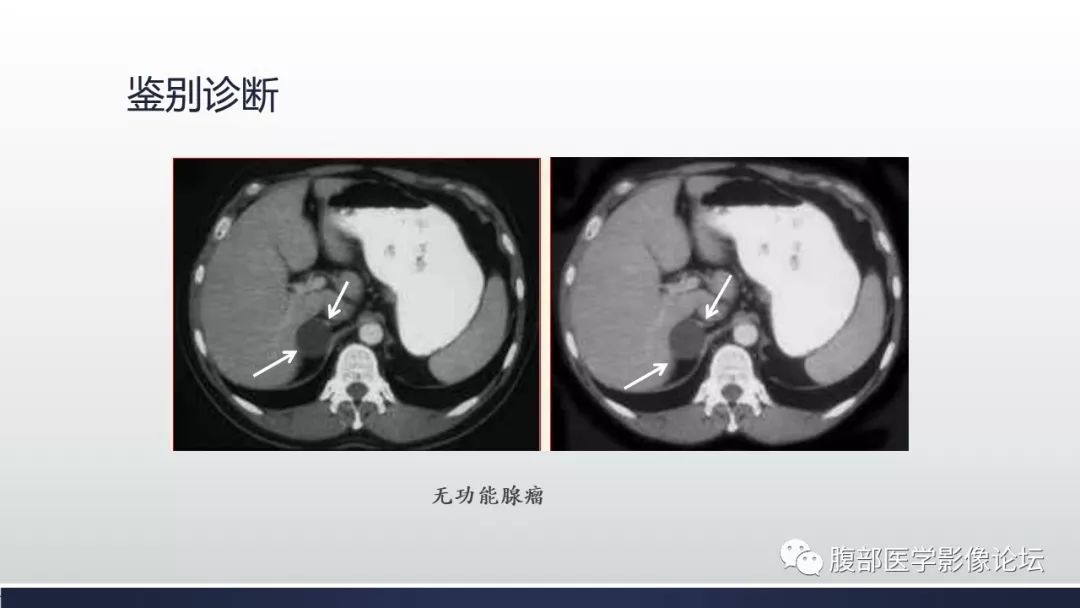 【病例】肾上腺平滑肌瘤1例CT影像鉴别诊断