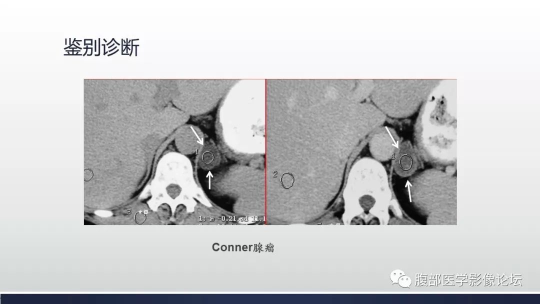 【病例】肾上腺平滑肌瘤1例CT影像鉴别诊断