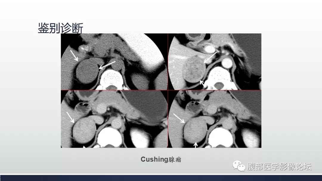 【病例】肾上腺平滑肌瘤1例CT影像鉴别诊断