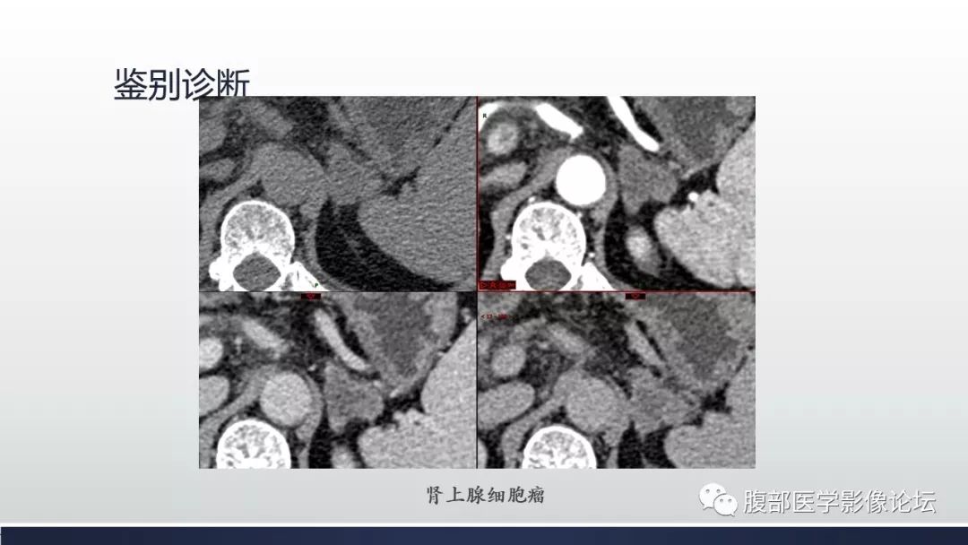 【病例】肾上腺平滑肌瘤1例CT影像鉴别诊断