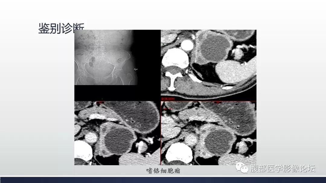 【病例】肾上腺平滑肌瘤1例CT影像鉴别诊断