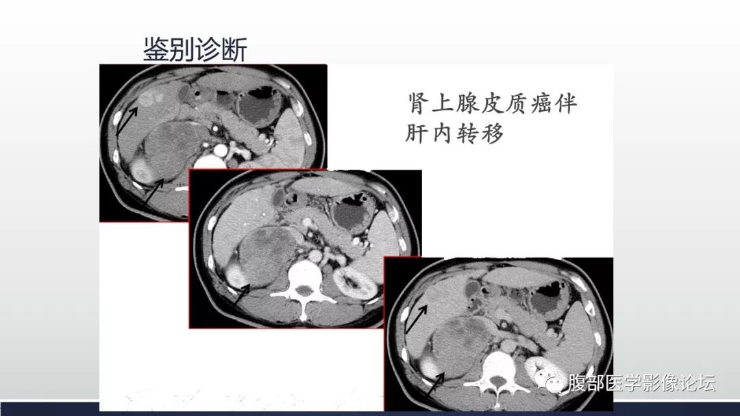 【病例】肾上腺平滑肌瘤1例CT影像鉴别诊断