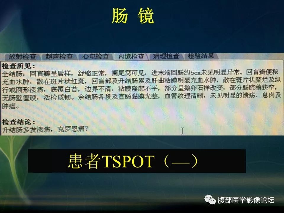 【PPT】小肠疾病读片—克罗恩病、肠结核、溃疡性结肠炎鉴别诊断
