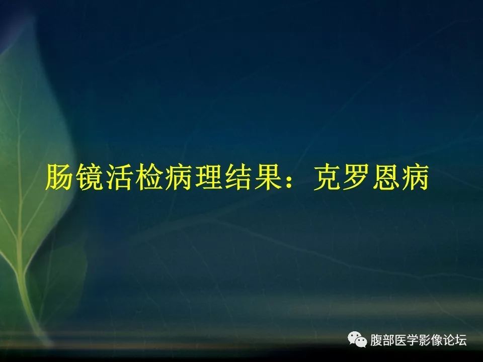 【PPT】小肠疾病读片—克罗恩病、肠结核、溃疡性结肠炎鉴别诊断