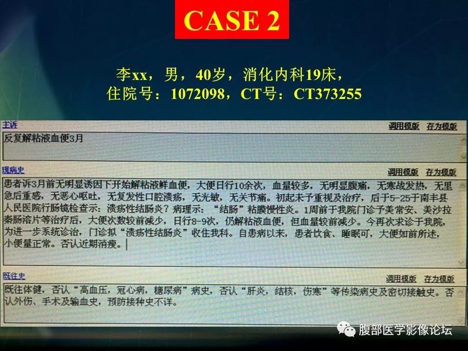 【PPT】小肠疾病读片—克罗恩病、肠结核、溃疡性结肠炎鉴别诊断