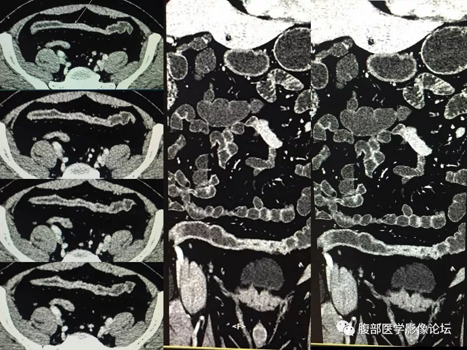 【PPT】小肠疾病读片—克罗恩病、肠结核、溃疡性结肠炎鉴别诊断