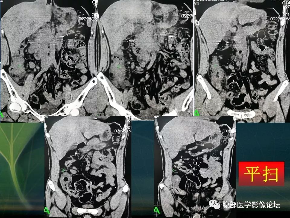 【PPT】小肠疾病读片—克罗恩病、肠结核、溃疡性结肠炎鉴别诊断